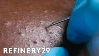 I Got Professional Blackhead Extractions  Macro Beauty  Refinery29 [upl. by Gunilla]