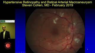 Hypertensive Retinopathy and Retinal Arterial Macroaneurysm [upl. by Narret]