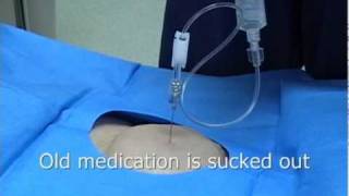 Intrathecal or Spinal Morphine pump or Baclofen pump refill procedure [upl. by Neiviv]