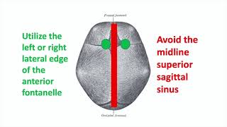 Ventricular CSF Tap via Fontanelle in an Infant with Hydrocephalus [upl. by Schlosser]