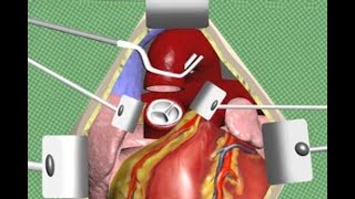 Aortic Valve Replacement Surgery Animation by Cal Shipley MD [upl. by Philis]