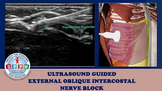 External Oblique Intercostal Ultrasound Guided Nerve Block [upl. by Adnov]