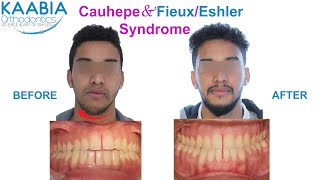 Cauhepe amp Fieux  Eshler Syndrome  Syndrome de Cauhepe et Fieux  Eshler [upl. by Courtland]