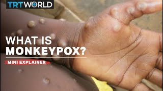 What is monkeypox [upl. by Shult]