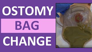 Ostomy Bag Pouch Change  Ostomy Care Nursing  Colostomy Ileostomy Bag Change [upl. by Nefets]