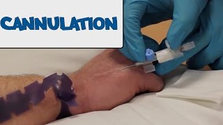 How to Perform Cannulation  OSCE Guide old version  UKMLA  CPSA [upl. by Ardnosak]