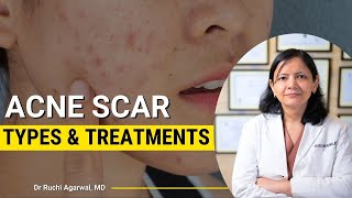 Acne scars treatment  Acne scars before and after  Acne Treatment Skincare  Acne treatment [upl. by Jehias]