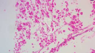 Coccidioides immitis under the microscope with GMSHaematoxylin and Eosin stain [upl. by Yssep962]