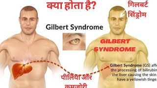 Gilbert SyndromeA disease or a normal condition [upl. by Koziarz566]