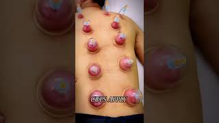 Cupping Therapy Patient for severe back pain [upl. by Grati747]