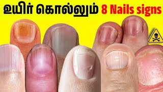 8 dangerous nail sign உங்க விரல் நகம் நல்லா இருக்கா Nail signs of Disease [upl. by Giah]