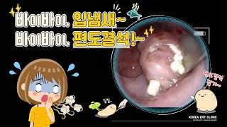 편도결석과 입냄새 구취는 왜 나는 걸까요 Bad breath amp tonsil stone [upl. by Okihcas]