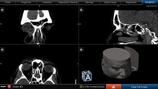 Bilateral revision endoscopic sinus surgery [upl. by Mairam394]