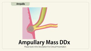 Ampullary Mass DDx [upl. by Endres]