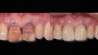 BOPT technique Ceramic crown set in anterior maxilla [upl. by Tatiania]