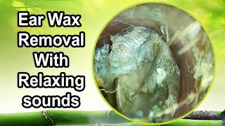 Ear wax removal with relaxing sounds [upl. by Adele]