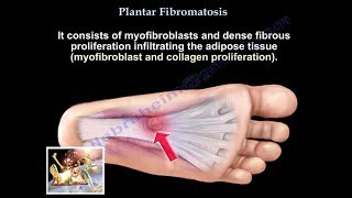 Plantar Fibromatosis  Everything You Need To Know  Dr Nabil Ebraheim [upl. by Onirefez]