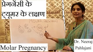 प्रेगनेंसी के ट्यूमर के लक्षण पहचाने और इलाज Molar Pregnancy Causes [upl. by Enial]