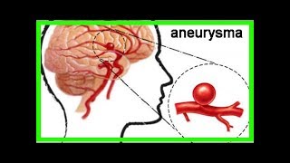 Aneurysma im Gehirn – Was ist das [upl. by Tunnell]