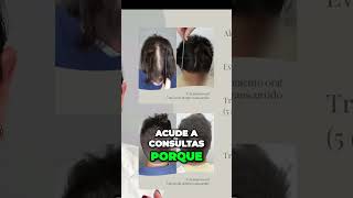 Caso de Alopecia Androgenética  Recuperando el Pelo [upl. by Artimas511]