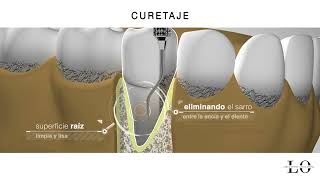 Periodoncia en Logroño raspado o curetaje [upl. by Thomas379]