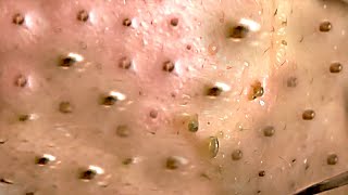 Amazing Blackheads Remover on the Face 019 [upl. by Toille]