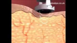 How Ultrasonic Cavitation Works [upl. by Atela]