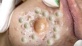 Big Cystic Acne Blackheads Extraction Blackheads amp Milia Whiteheads Removal Pimple Popping  4768 [upl. by Nnaeinahpets]