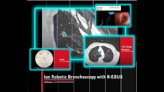 Ion Robotic Bronchoscopy with Radial EBUS [upl. by Richers957]