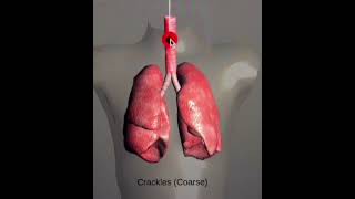 Lung SoundsNormal and AbnormalCracklesWheeze StridorRonchiOn Respiratory Auscultation Sound [upl. by Arihs]