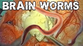 Mango Worms on the Brain Medical College Exclusive [upl. by Agripina249]