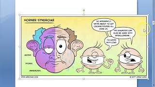 Ophthalmology Horner syndrome Horners Horners pupil triad oculo sympathetic paralysis Anisocoria [upl. by Kirk469]