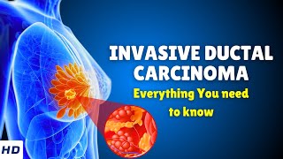 Invasive Ductal Carcinoma Breast Cancer – Causes Signs and Symptoms Diagnosis amp Treatment [upl. by Goran]