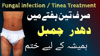 fungal infection treatment  tinea treatment  fungal infection in private parts  terbisil cream [upl. by Ennovy]