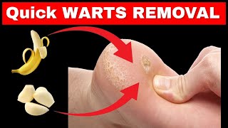 Wart Removal How to get rid of plantar warts PERMANENTLY at Home [upl. by Elocal715]