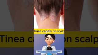 Whats wrong with scalp fungal infection  Doctor explains tinea capitis idoctor [upl. by Harraf108]