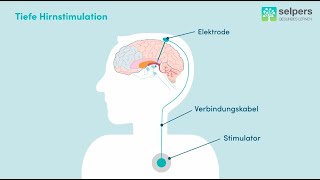 Morbus Parkinson  Tiefe Hirnstimulation Experte erklärt [upl. by Leihcim]