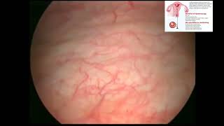 CystoscopyBladder Uterus Exam Cystoscopy Hysteroscopy ProcedureUrology Gynecology Treatment [upl. by Artined536]