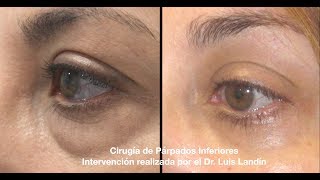 Blefaroplastia inferior bolsas ojos fotos antes y después sin cicatriz [upl. by Doug]