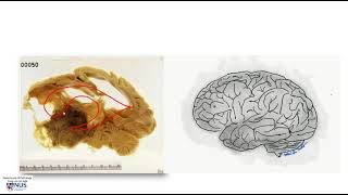 Brain Ependymoma with hydrocephalus [upl. by Weihs225]