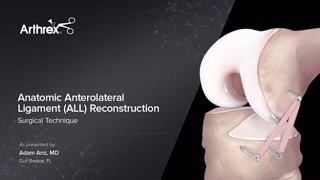 Anatomic Anterolateral Ligament ALL Reconstruction [upl. by Xyla]