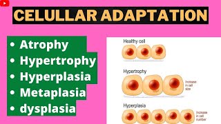 Cellular Adaptation Pathology  Atrophy  Hypertrophy  Hyperplasia  Metaplasia  Dysplasia [upl. by Aeret]