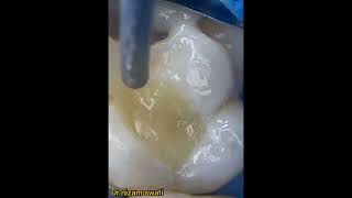 how to fil dental teeths filing procedure [upl. by Ziul421]