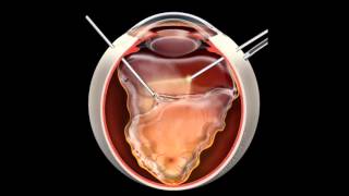 Retinal Detachment  Signs Symptoms and Treatment [upl. by Razaile816]