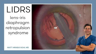 LIDRS lensiris diaphragm retropulsion syndrome Explanation and Demonstration [upl. by Junieta]