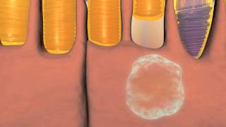 Animation of Wet and Dry Macular Degeneration [upl. by Gersham]