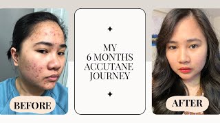 My Accutane Journey [upl. by Ainocal69]