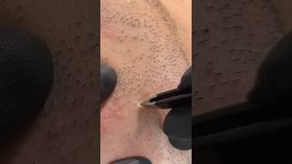 yoasobi スッキリ blackheads 毛抜き beard ストレス発散 facialhair [upl. by Luckett331]