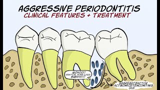 Aggressive Periodontitis Part 2  Clinical features and treatment [upl. by Asila589]