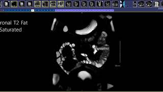 How to read an MR Enterography [upl. by Atinrahc]